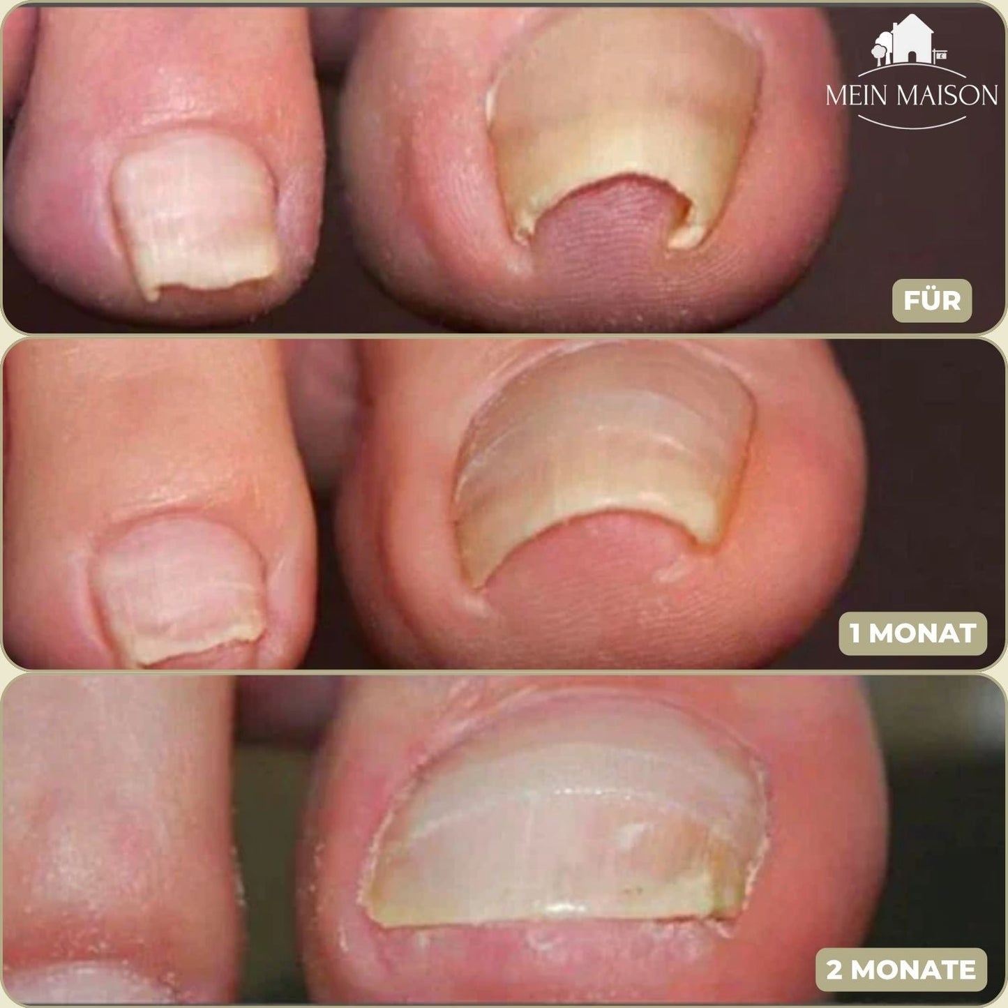 10+10 GRATIS | FixaNail - Directe Nagelreparatie