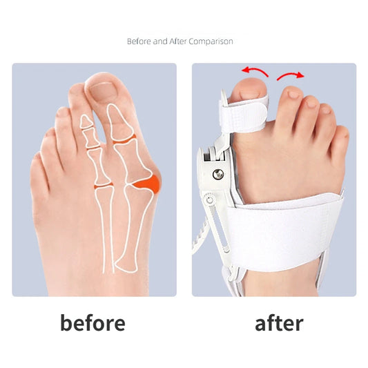 Hallux Valgus Corrector Bunions For Toes